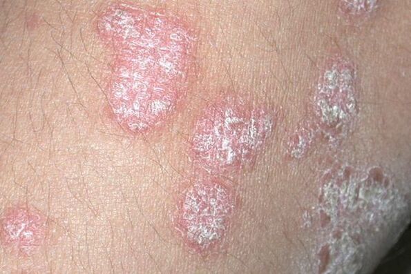 Psoriáza spôsobená plesňovou infekciou