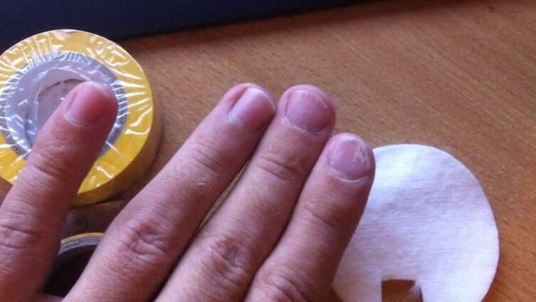 nechtová huba a jej liečba ľudovými prostriedkami